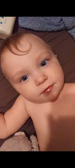 Does sparse hair at 1 year old predict future hair?