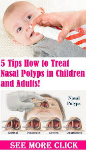 It is believed that inflammation causes the buildup of fluid. 15 Best Polyps Ideas Polyp Allergy Remedies Natural Remedies