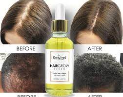 The formula is said to be packed with ingredients like coffee extract, cayenne and apple stem cells to help energize roots and fortify strands. Formula D Hair Regrowth Serum For Ccca Etsy Hair Elixir Alopecia Hair Growth Grow Hair