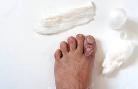 Black and red bruised toe next to the nail. A Close Up Photo Of A Broken Big Toe With Several Cuts And Bruises Stock Photo Picture And Royalty Free Image Image 146447362