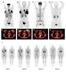 The complete metabolic/molecular response to chemotherapy combined with  [177Lu]Lu-FAP-2286 in metastatic breast cancer