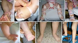 We did not find results for: Functional Physiotherapy Method Results For The Treatment Of Idiopathic Clubfoot