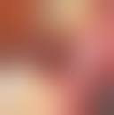 Image result for Alveolitis sicca)