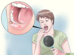 Biting The Inside Of Your Cheek Treatment Remove A Mouth Ulcer Ulcer Causes Cold Sore Sore In Mouth Remedies