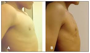 Consult a doctor for medical advice. Clinical Experience With Orthotic Repair Of Pectus Carinatum Annals Of Saudi Medicine