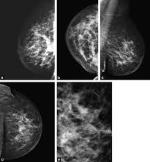 Invasive breast cancer can appear as a white patch or mass on a mammogram. Imaging Inflammatory Breast Cancer Sciencedirect