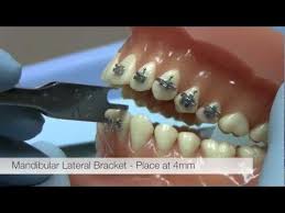 American Orthodontics Alexander Lts Brackets Bracket