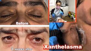 Image result for xanthelasma of eyelid