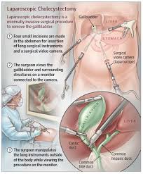 Cholecystectomy Gall Bladder Removal In This Week S Jama Patient Page We Discuss Laparoscopic Chol Surgical Nursing Medical Anatomy Laparoscopic Surgery