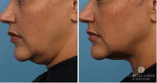 Along with it comes many changes in the body, particularly the skin and face. How Can I Get Rid Of Sagging Jowls Without Surgery Chevy Chase Kybella Capital Laser Skin Care