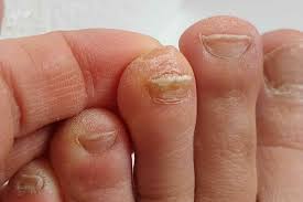 Image result for onychomycosis