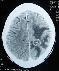A procedure to find malignant tumor cells in the brain. File Ct Brain Tumor Jpg Wikimedia Commons
