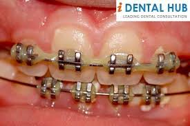 We did not find results for: How To Clean Stains After Braces Spacers For Braces After Braces Dental Braces