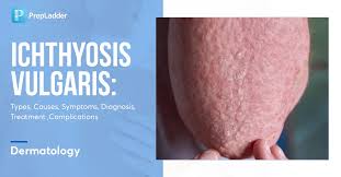 Image result for Ichthyosis