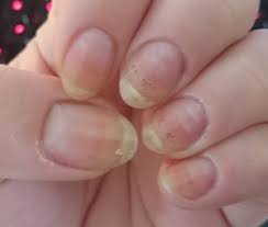 Black spot on thumb cuticle. Ask Ana Black Spots In Nails Nail Care Hq