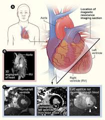 Image result for Cardiac MRI