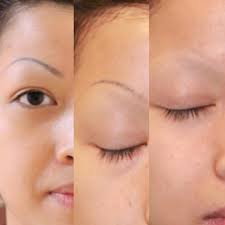 However body tattoos are treated too. Cosmetic And Eyebrow Tattoo Removal Removery