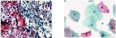 Iata ce presupune examinarea, ce rol are testul si ce inseamna. Citologie Cervico Vaginala Babes Papanicolaou In Mediu Lichid Synevo