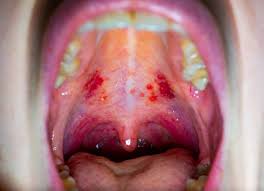 Image result for Oral herpes roof of mouth