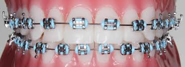 Understanding Metal Braces for Orthodontic Treatment