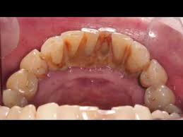 This contributes to tooth decay, gum disease and eventually tooth loss from smoking. Smokers Teeth How To Remove Smoking Stains From Teeth