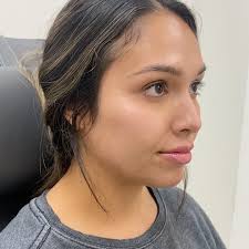 Here is what 3 syringes of filler looks like right after injection. Very  natural. I treated her cheeks, jawline, chin, and lips. 💉 For this beauty  it’s all about prevention, so I restored some of her ...
