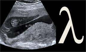 For the second lambda/closure object, an assignment to the function pointer triggers the same conversion as. Radiology Signs Lambda Sign Describes The Triangular Appearance