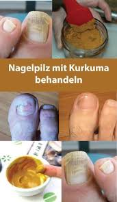 Nagelpilz Mit Kurkuma Behandeln Anita Spatzier Nagelpilz Nagelpilz Hausmittel Fusspilz Behandeln