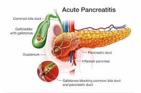 What are the signs of pancreatitis? Pancreatite Acuta Dalla Diagnosi Al Trattamento