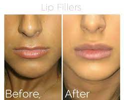 If you have mild disease, fever is likely to settle within a few this occurs because the infection takes hold deep in your lungs, leading to inflammation which while the nhs test and trace system has been beset by problems, it does by now have capacity to test. Lip Cheek Jawline Nose Bridge Augmentation