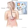 Stomach cancer is most commonly diagnosed in people over the age of 65. 1