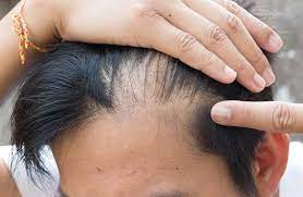 Male pattern baldness is linked to a sensitivity to the hormone dihydrotestosterone and usually manifests as a receding hairline or ring of. How Much Hair Loss Is Normal A Guide For Young Gents The Bald Gent