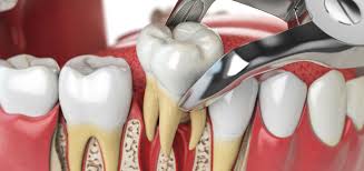 Tooth extraction | Legacy Surgery | Oral surgeon Harrisonburg