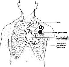 The pacemaker rhythm can easily be recognized on the ecg. Permanent Pacemaker An Overview Sciencedirect Topics