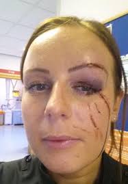 Cops left with fractured skulls and gouged eyes after being battered