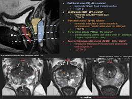 The experts at webmd explain prostate cancer, including causes. Epos Trade