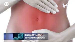 Que Es Y Como Se Trata Una Hernia Umbilical Youtube