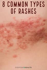 8 Common Types Of Rashes Rashes Remedies Fungal Infection