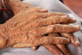 Neurofibromatosis type 1 (nf1) is a multisystem genetic disorder that commonly is associated with cutaneous, neurologic, and orthopedic manifestations. Neurofibromatosis Familydoctor Org