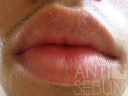 Image Of Fordyce Spots On Lips Remedios Caseros Remedios