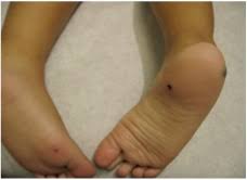 Blue Rubber Bleb Nevus Syndrome Bean Syndrome Dermatology Advisor