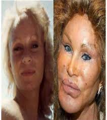 Getty images jocelyn wildenstein is a poster child for plastic surgery gone wrong, says dr. 60 Worst Cases Of Celebrity Plastic Surgery Gone Wrong