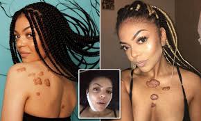 A keloid, is a type of overgrown scar, or an overly aggressive healing response to a wound. Bianca Lawrence Proudly Shows Off Her Keloid Scars In Viral Photos Daily Mail Online
