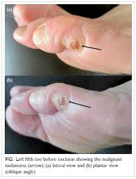 Answers from hundreds of doctors about benign to serious symptoms. Amelanotic Melanoma Masquerading As A Pyogenic Granuloma Caution Warranted Hkmj