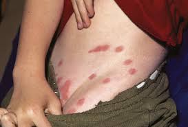 Image result for mite bites on humans