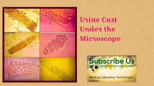 Image result for Urinary Cast