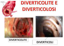 La stenosi diverticolare sintomatica del colon è un restringimento del tratto intestinale dovuto alla proliferazione dei batteri all'intero dei diverticoli, sporgenze naturali causate da un aumento di. Jn3vqssf5ksfam
