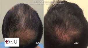 New york and california are the epicenters of most major airlines run direct flights to and from cities in california, including san francisco, los angeles, san diego, irvine, oakland, and sacramento. Crown Hair Transplant Dermhair Clinic Los Angeles 1 310 318 1500