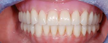 Image result for Occlusal