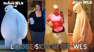 What To Do About Loose Skin After Bariatric Surgery Loose Skin Bariatric Surgery Bariatric